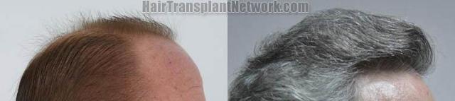 Hair transplantation surgery before and after images