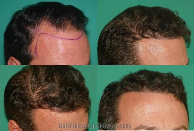 Hair transplantation surgery before and after pictures