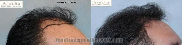 Hair transplantation surgery before and after photos