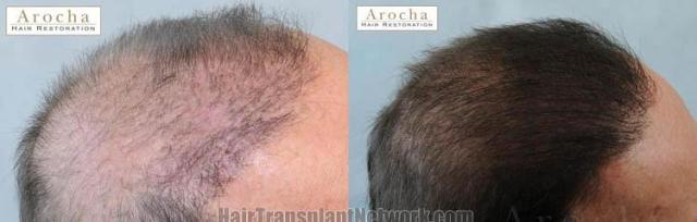 Hair transplantation surgery before and after photos