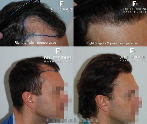 Hair transplantation surgery before and after images