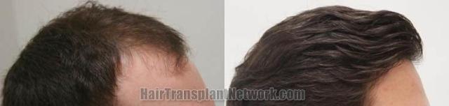 Hair transplantation surgery before and after images