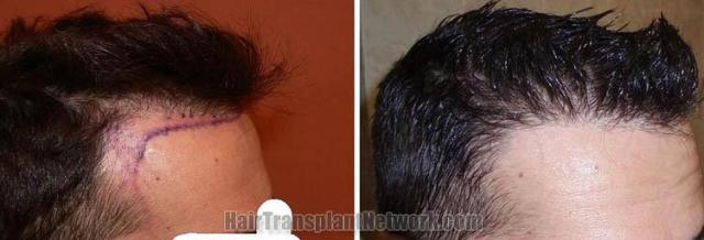 Hair transplantation surgery before and after photos