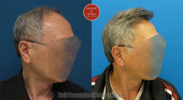 Hair transplantation surgery before and after images