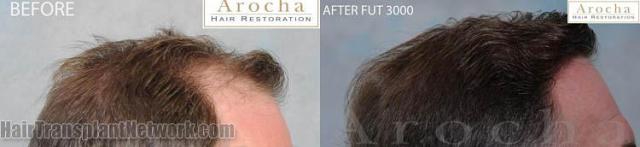 Hair transplantation surgery before and after images