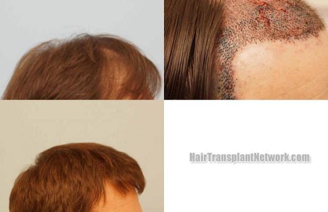 Hair restoration procedure before and after results