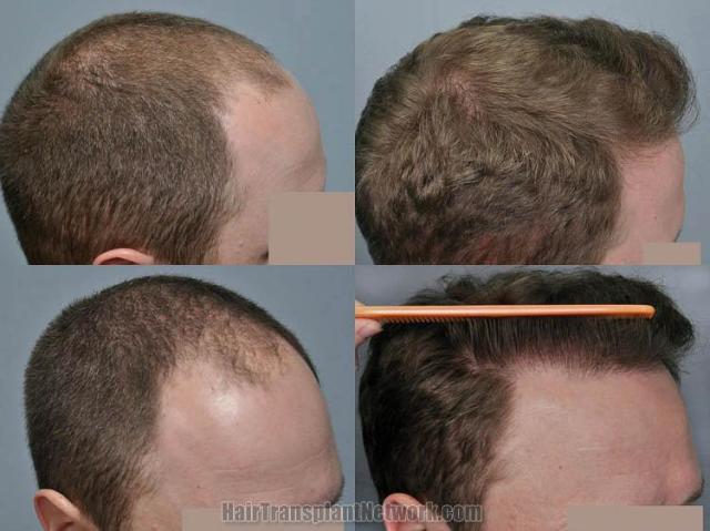 Hair transplantation surgery before and after images