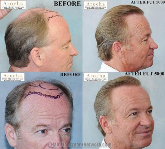 Hair transplantation surgery before and after photos