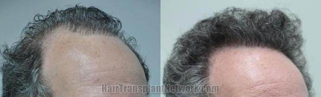 Hair transplantation surgery before and after images