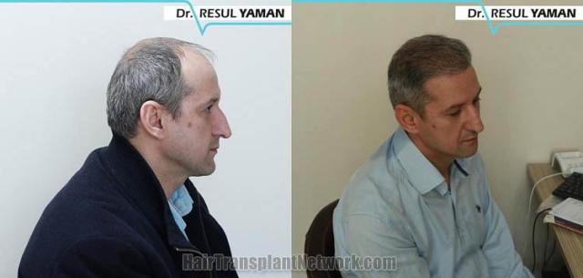 Hair restoration procedure before and after results