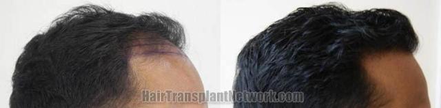 Hair restoration procedure before and after results