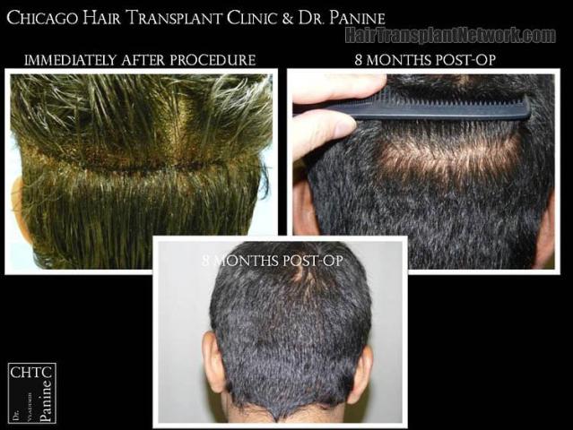 Hair restoration procedure results