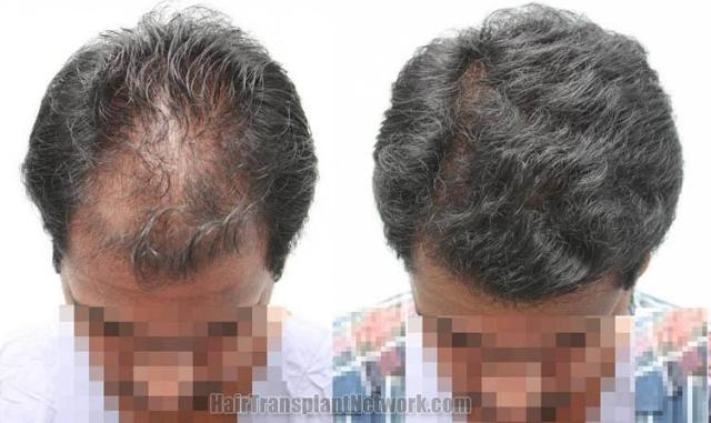 Top view - Before and after surgical hair replacement