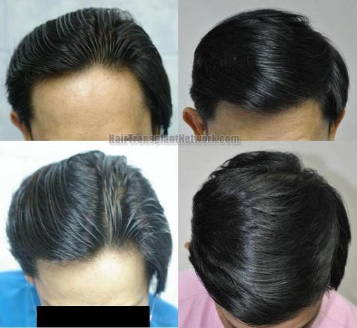 Top view before and after hair restoration results