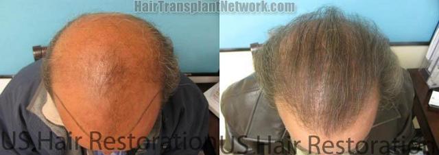 Hair transplantation surgery before and after photos