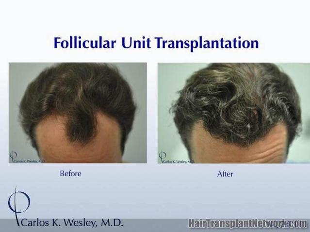 Before and after hair transplant procedure images