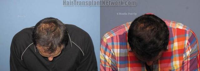 Hair transplant surgery before and after images