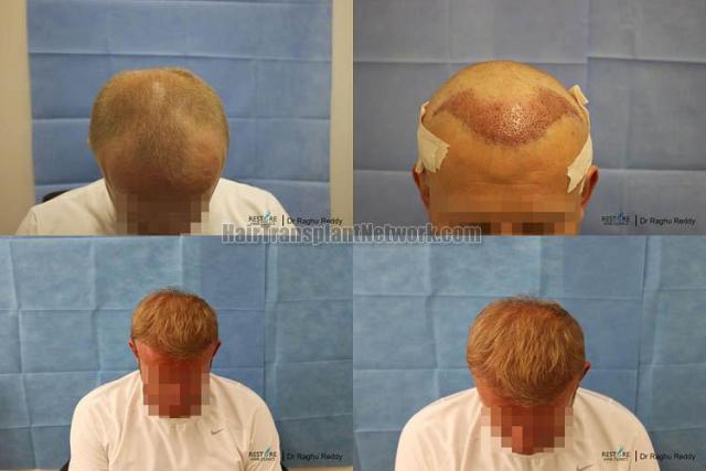 Hair transplantation surgery before and after pictures