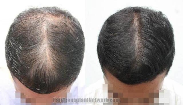 Top view before and after hair restoration results