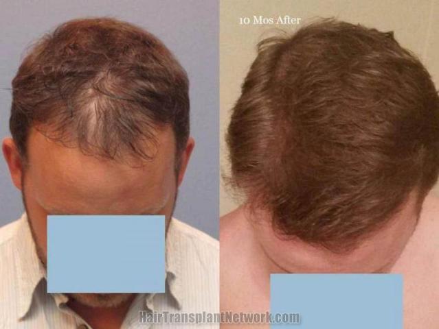 Hair transplantation surgery before and after photos