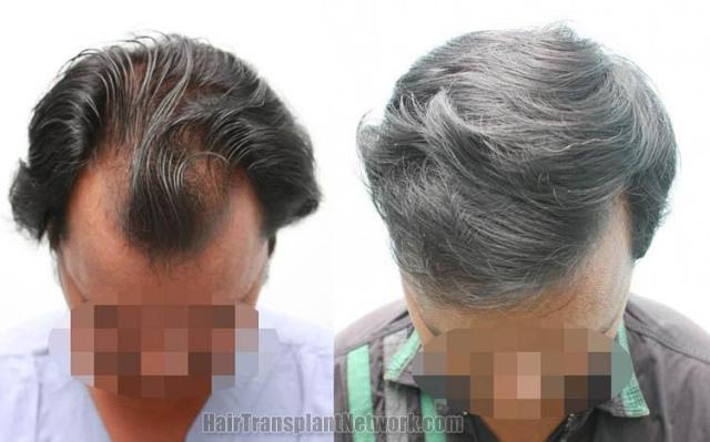 Hair transplantation surgery before and after images