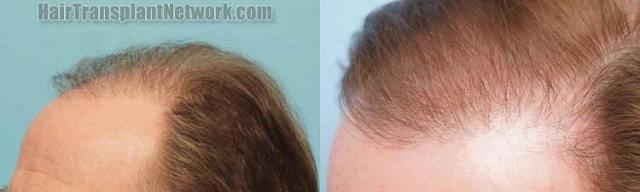 Hair transplantation surgery before and after images