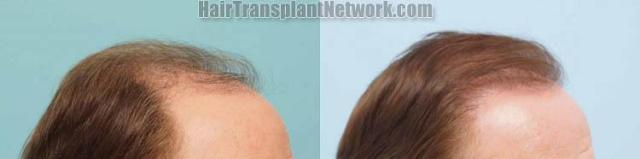 Hair transplantation surgery before and after photos