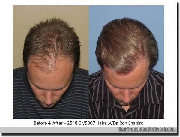 Hair restoration procedure results