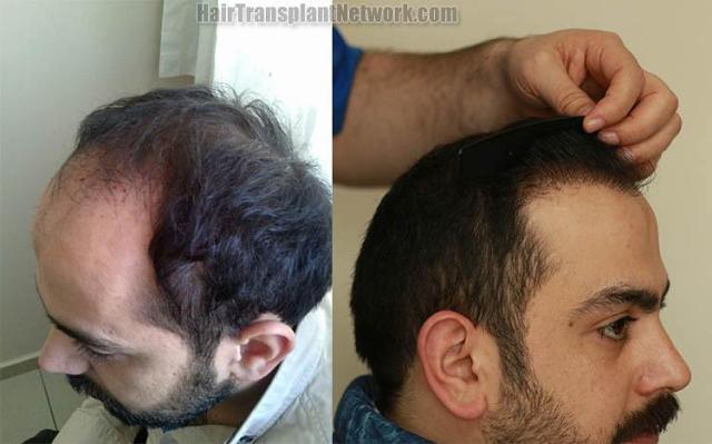 Hair transplant surgery before and after photos