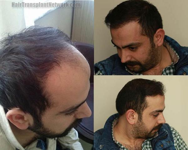 Hair restoration surgery before and after photographs