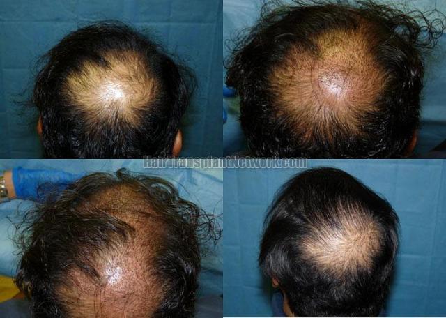 Hair transplantation procedure before and after images