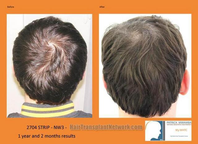 Hair restoration procedure before and after pictures