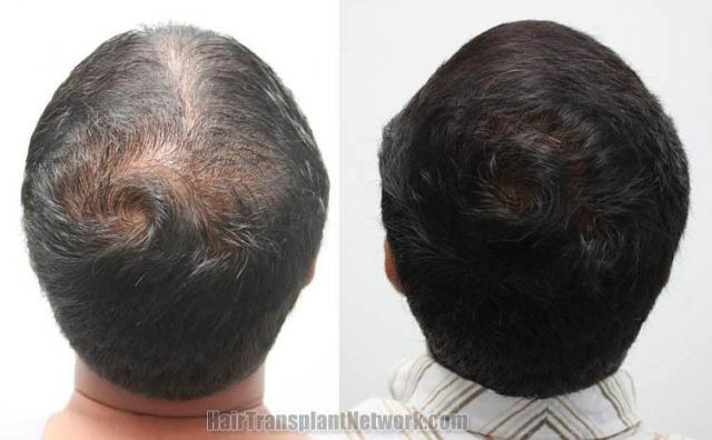 Back view before and after hair transplantation photos