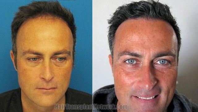 Before and after hair transplant procedure images