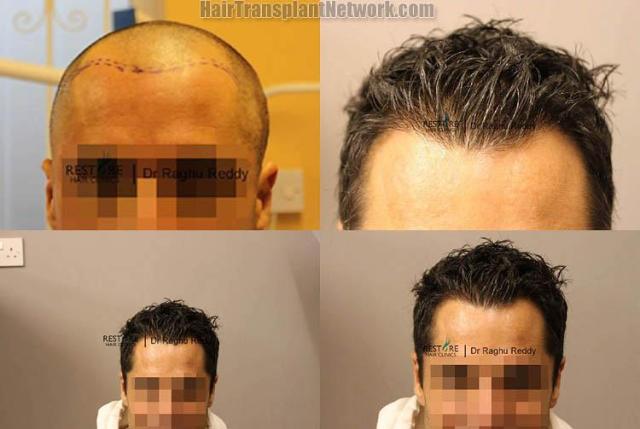 Hair restoration procedure before and after results