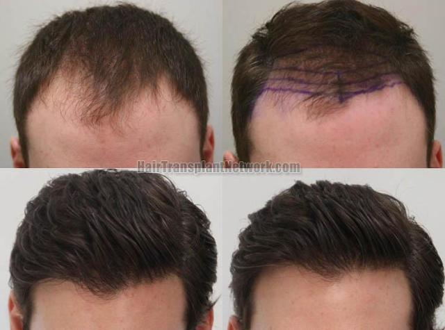 Hair restoration procedure before and after results