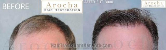 Hair restoration procedure before and after results