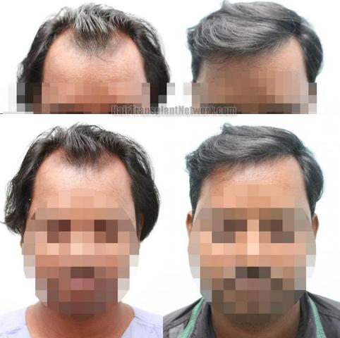 Before and after hair transplantation result photographs