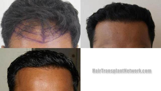 Hair transplantation surgery before and after photos