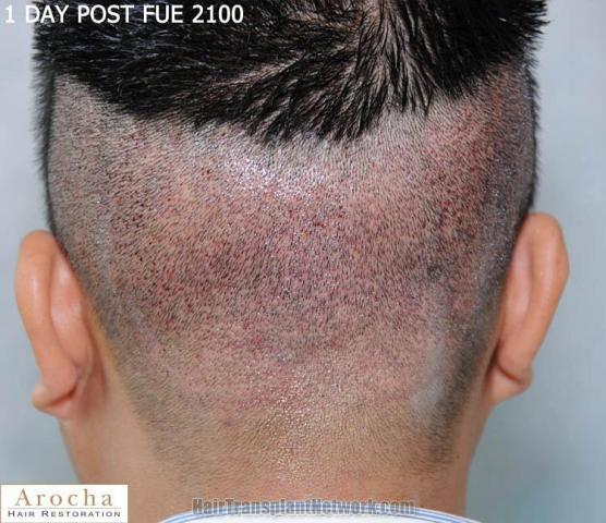 Hair restoration procedure before and after pictures