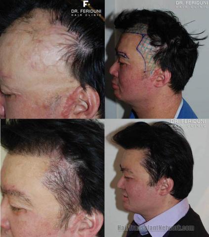 Left profile view before and after hair restoration on burn victim