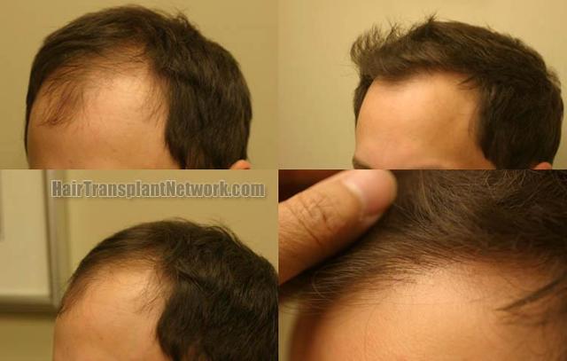 Hair transplantation surgery before and after pictures