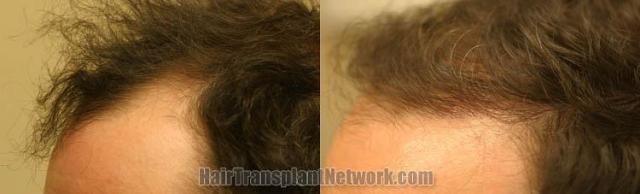 Hair transplantation surgery before and after pictures