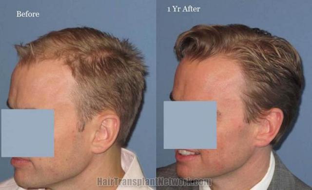 Hair transplantation surgery before and after photos