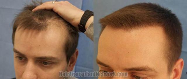 Hair transplantation surgery before and after photos