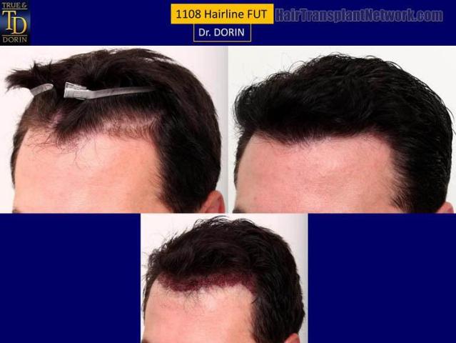 Hair transplantation surgery before and after pictures