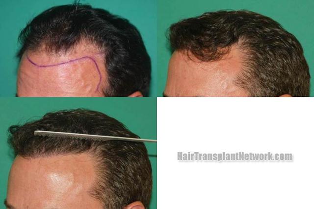 Hair restoration procedure before and after pictures