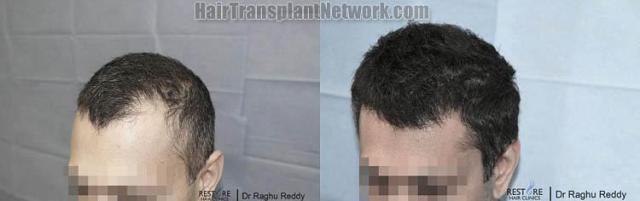 Hair transplantation surgery before and after images