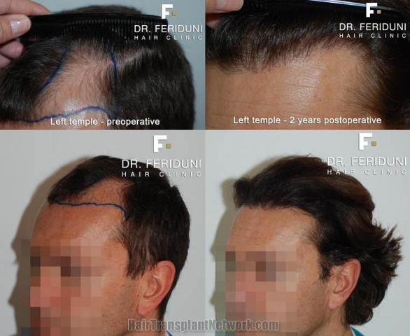 Hair transplantation surgery before and after pictures