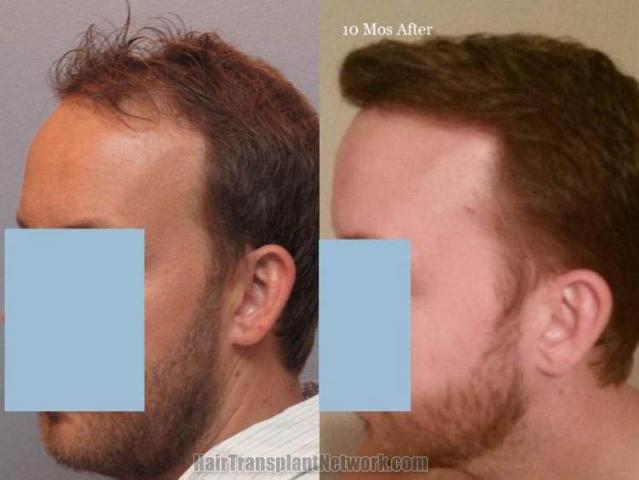 Hair transplantation surgery before and after pictures